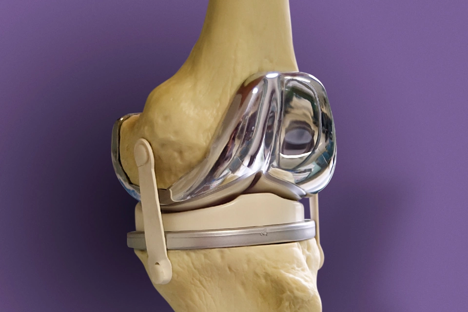 knee implant